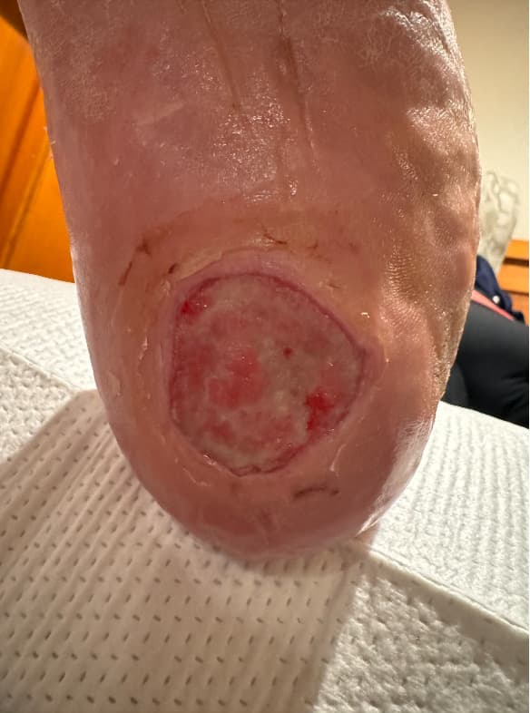 Diabetic & Neuropathic Ulcers