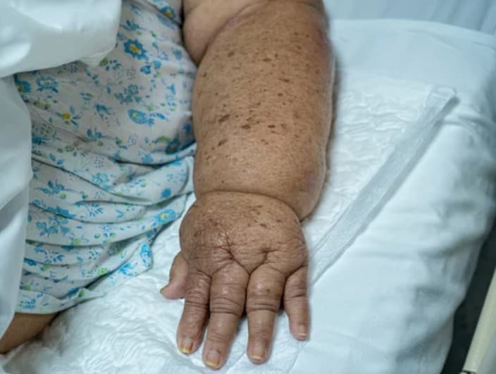 Lymphedema/Lymphatic Ulcers